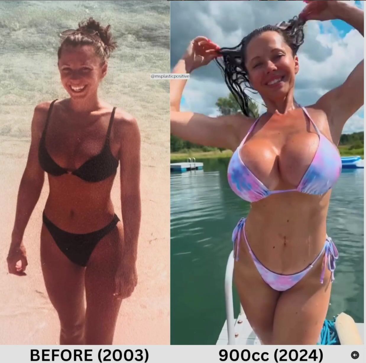 before and after implants