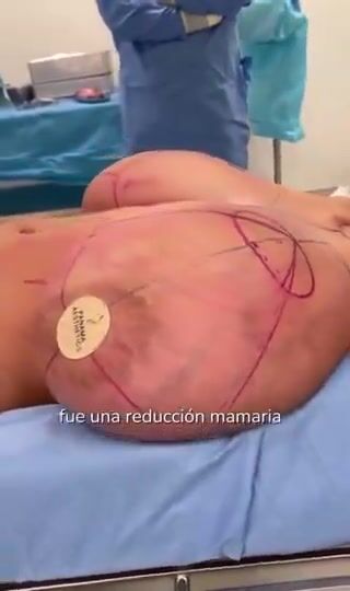 Gigantomastia Breast Reduction Pre-Op