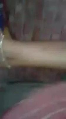 Stomach trampling