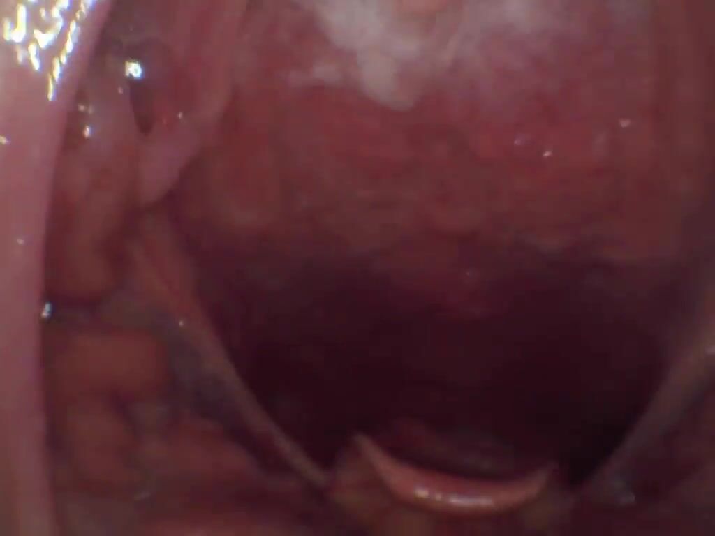 kimuvula endoscope throat