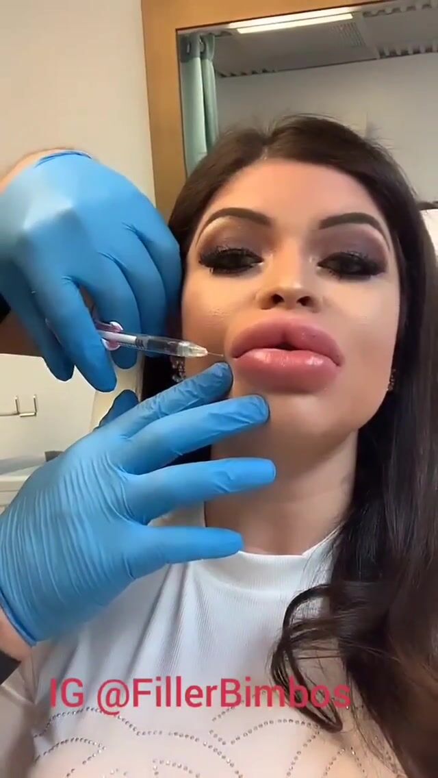 big fake lips filler