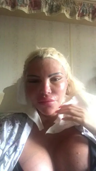 amanda lovelie big unveil here s a video of me taking the bandages off still very swollen as you can s xxx onlyfans porn videos