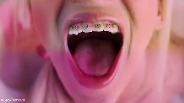 Do you like braces?